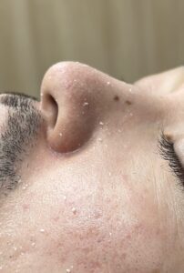 ◎角質ポロポロでワントーン明るいツルすべ肌へ！【仙台 愛子】